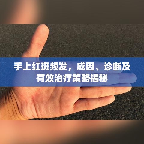 手上紅斑頻發(fā)，成因、診斷及有效治療策略揭秘