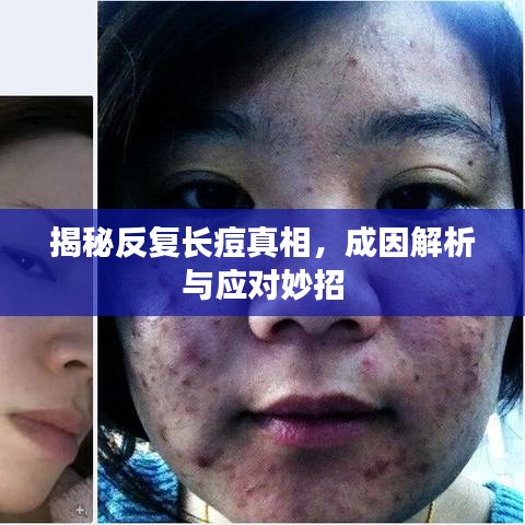 揭秘反復長痘真相，成因解析與應對妙招