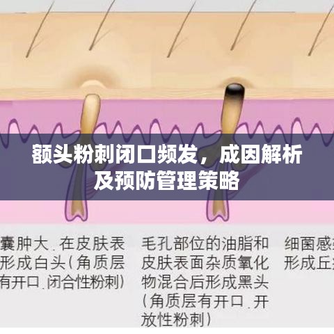 額頭粉刺閉口頻發(fā)，成因解析及預(yù)防管理策略